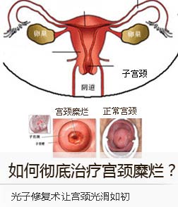 如何彻底治疗宫颈糜烂？