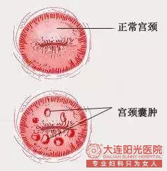 宫颈囊肿