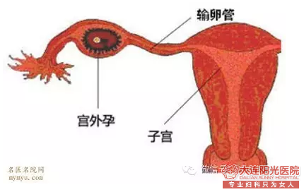 宁德妇科：宫外孕手术费用贵不