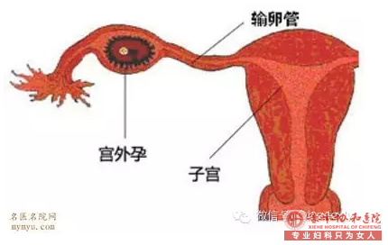 宁德第二医院宫外孕早期症状严重吗？