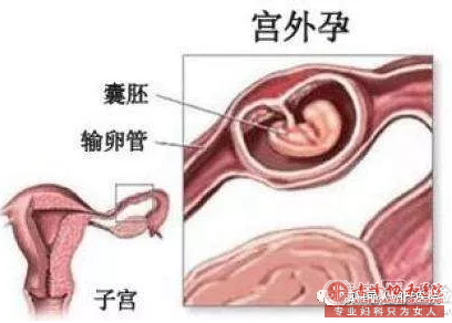 宁德同济医院宫外孕怎么处理